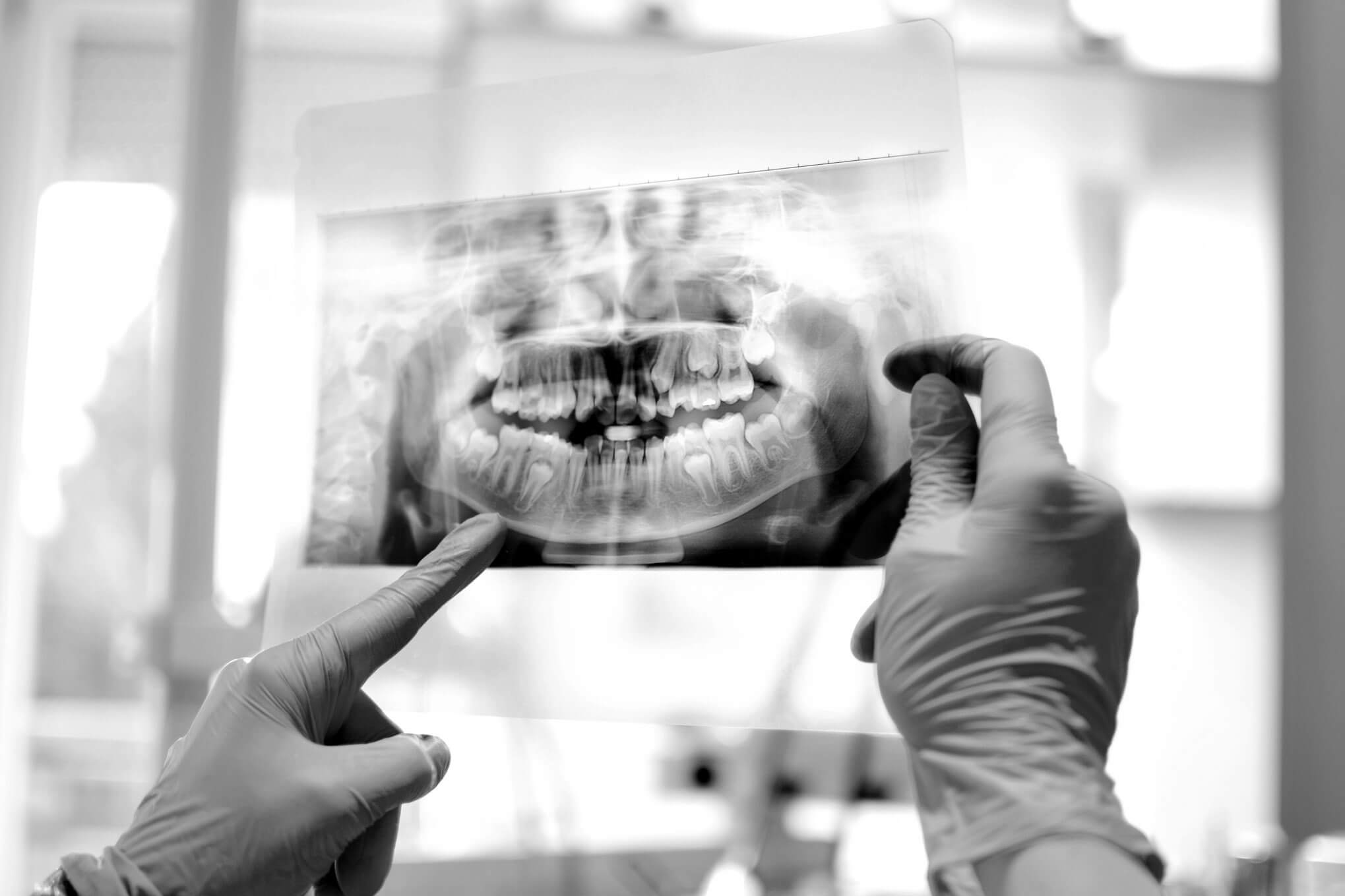 An X-ray image of a persons teeth.