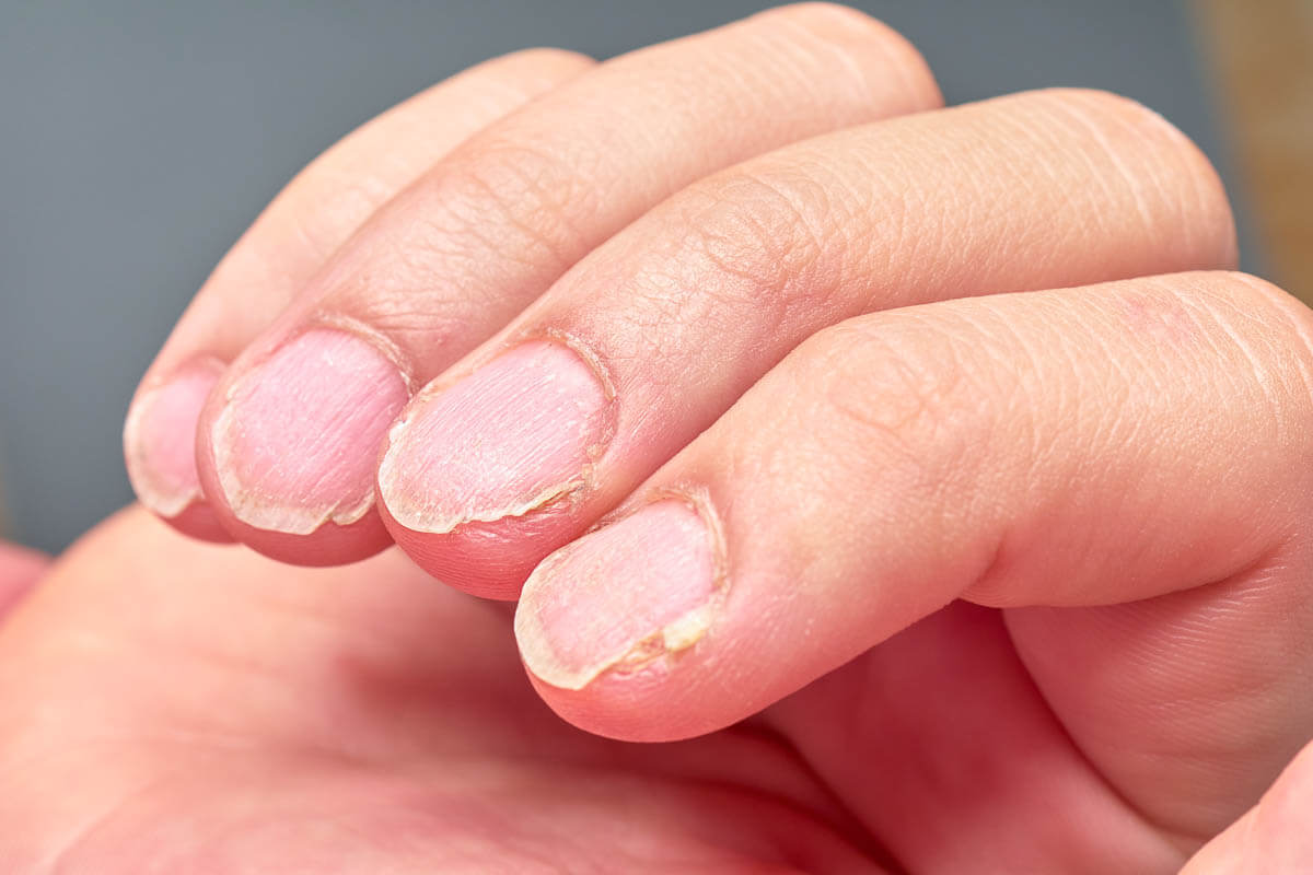 What Do Your Toenails Say About Your Health? Clubbing, Spoon, Yellowing &  Other Toenail Problems – Belmont Anderson DPM Las Vegas Podiatrist