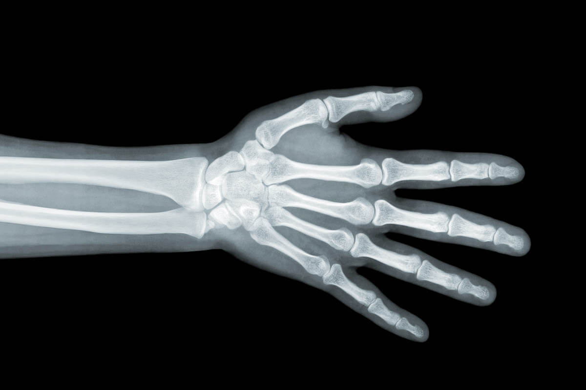 Переломы скелета. Рентген кисти норма. Рентген кисти правой руки норма. Лучезапястный сустав рентген здоровой руки. Рентгеновский снимок кисти.